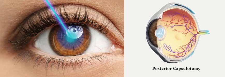 Posterior Capsulotomy